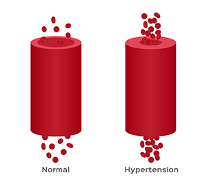 blood pressure