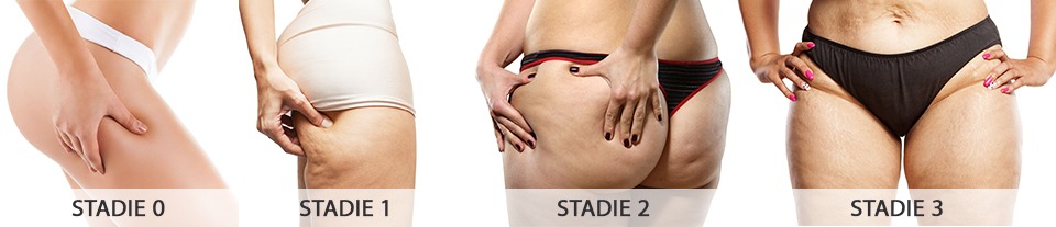 Hvad er appelsinhud og cellulite?