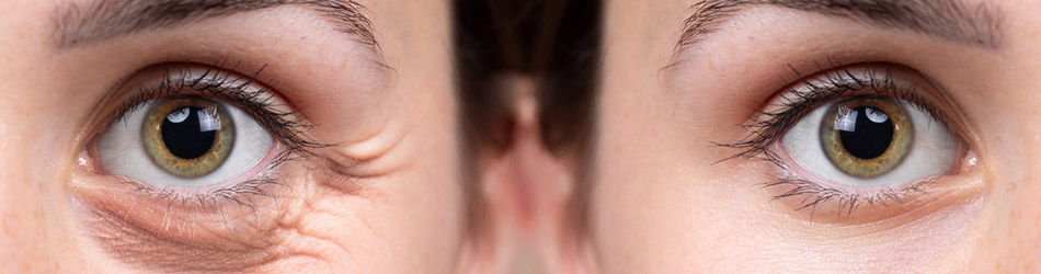 poser under øjnene opstår ofte på grund af manglende elasticitet.