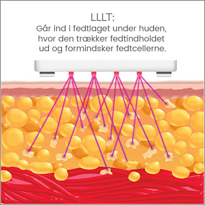LLLT-teknologi i silk'n lipo LLLT-teknologi i silk'n lipo