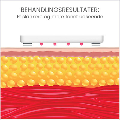 Behandling med silk'n lipo Behandling med silk'n lipo