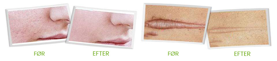 wwdk-skinception-dermefface-fx7-before-after wwdk-skinception-dermefface-fx7-before-after