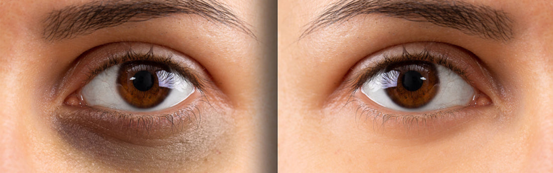 Sådan fjerner du poser under øjnene med K-vitamin