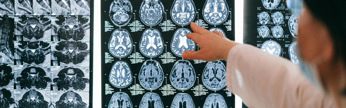 Forskning: Kvinder med alzheimers har lavere omega3-niveauer